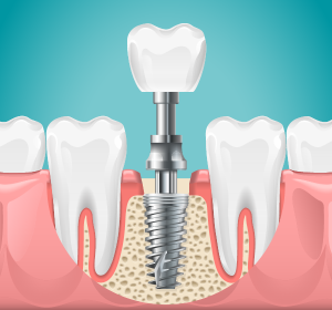 Zubné implantáty - Žilina