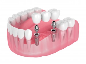 Zubné implantáty – Žilina